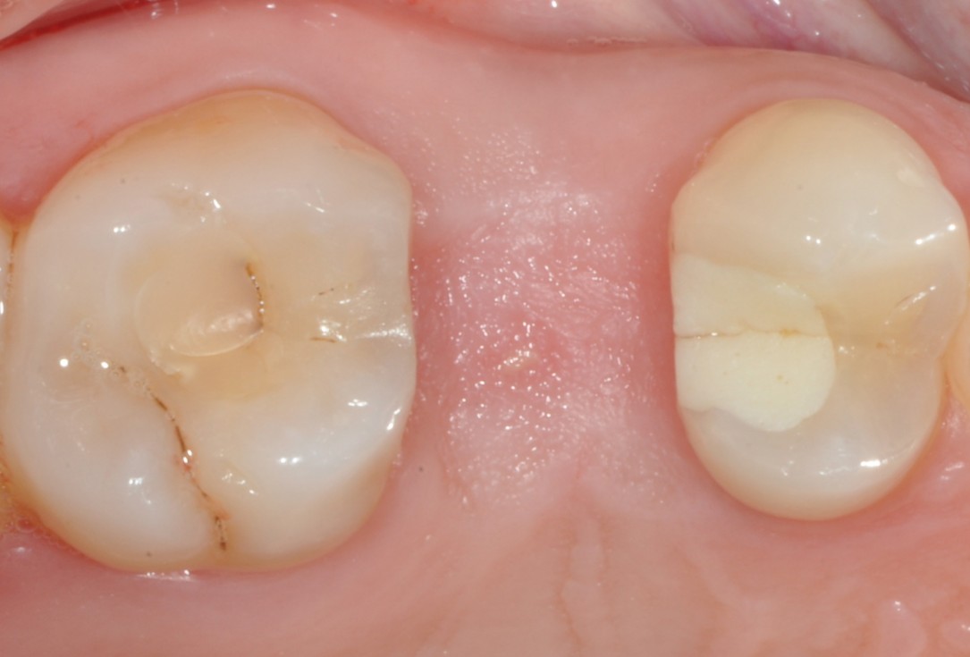 Application of collacone® to extraction socket