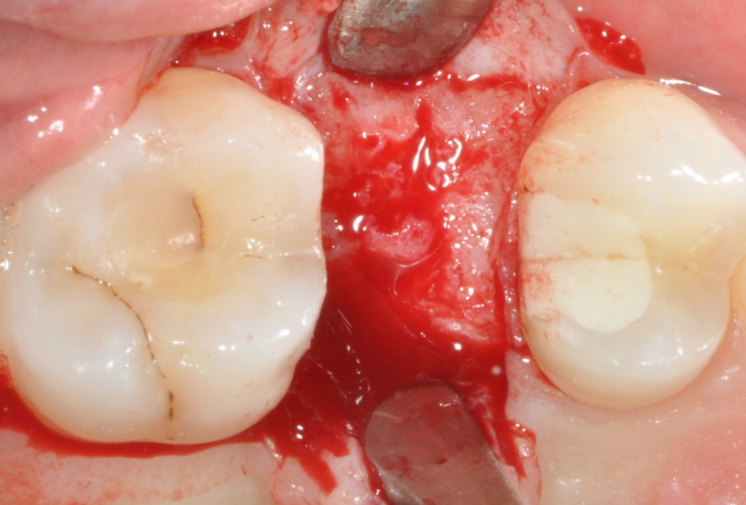Application of collacone® to extraction socket