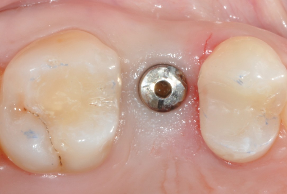 Application of collacone® to extraction socket