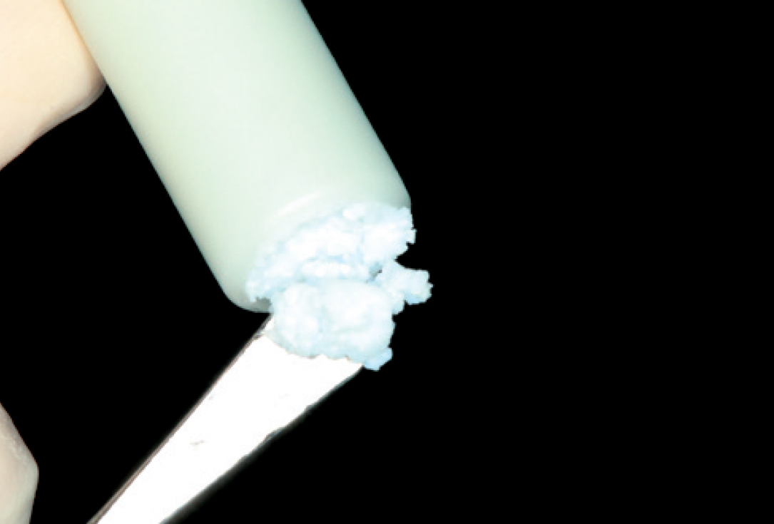 Internal Sinus lift - Dr. Frank Kistler