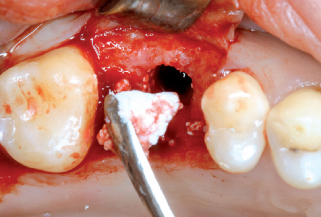 Internal Sinus lift - Dr. Frank Kistler