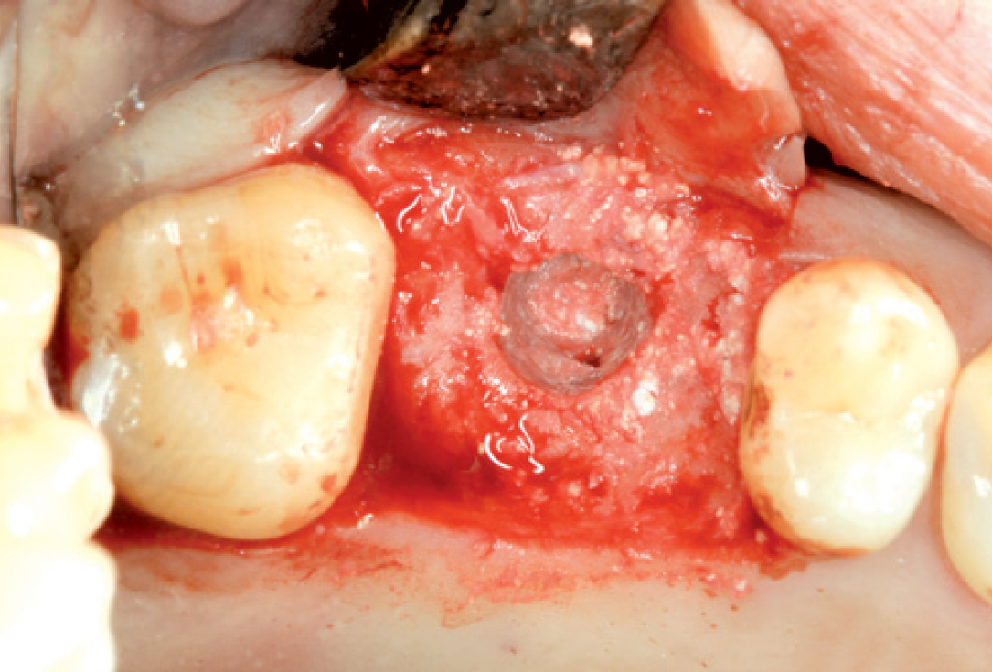 Internal Sinus lift - Dr. Frank Kistler