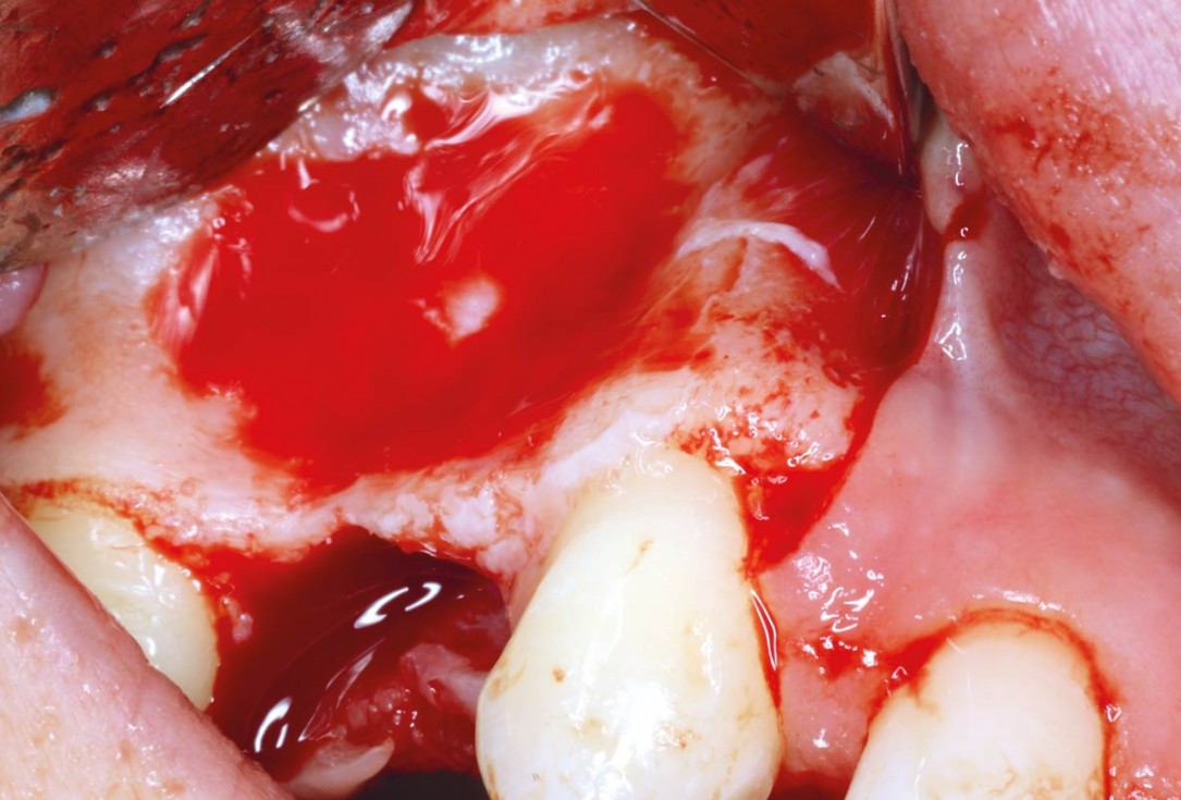 Ridge reconstruction with maxgraft® block in the posterior maxilla - Dr. A. Puišys