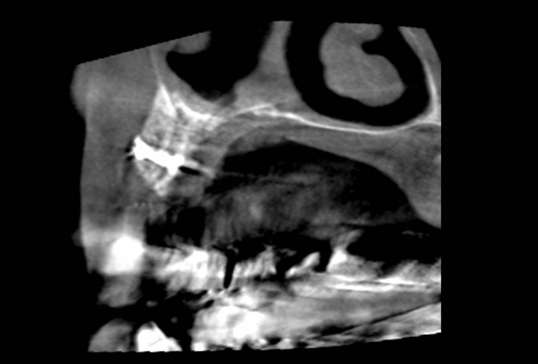 Smile rehabilitation in the anterior maxilla with maxgraft® bonebuilder - Dres. Dagba and Mourlaas  