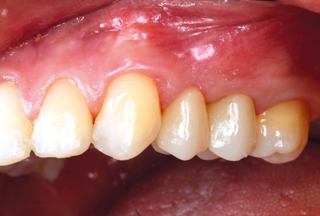 Ridge reconstruction with maxgraft® block in the posterior maxilla - Dr. A. Puišys