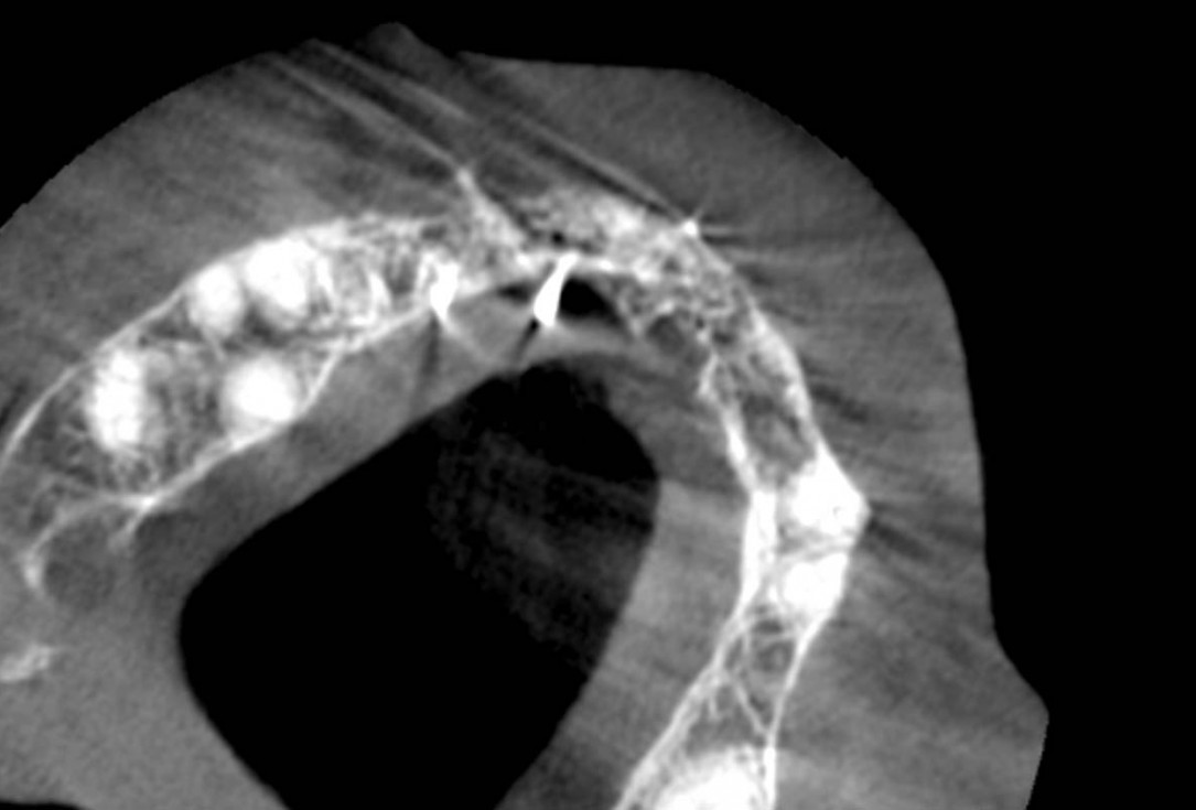 Smile rehabilitation in the anterior maxilla with maxgraft® bonebuilder - Dres. Dagba and Mourlaas  