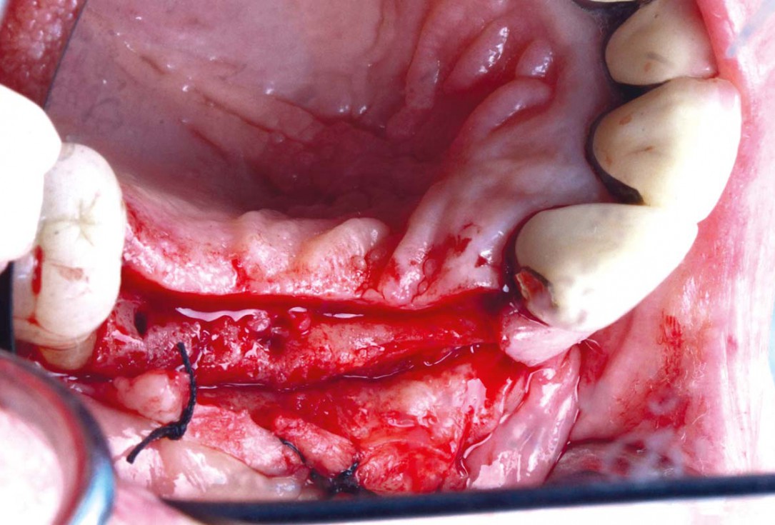 Smile rehabilitation in the anterior maxilla with maxgraft® bonebuilder - Dres. Dagba and Mourlaas  