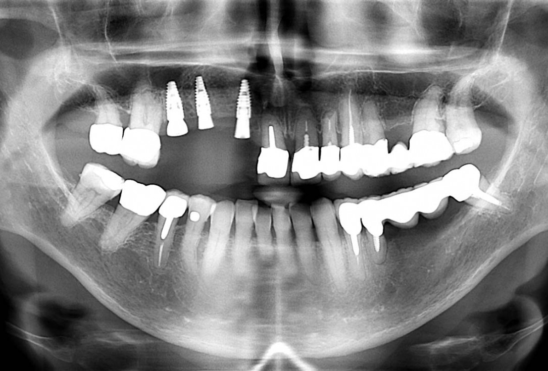 Smile rehabilitation in the anterior maxilla with maxgraft® bonebuilder - Dres. Dagba and Mourlaas  