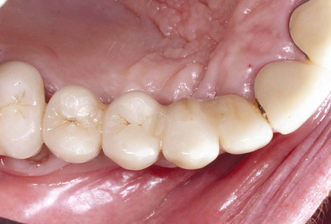 Smile rehabilitation in the anterior maxilla with maxgraft® bonebuilder - Dres. Dagba and Mourlaas  