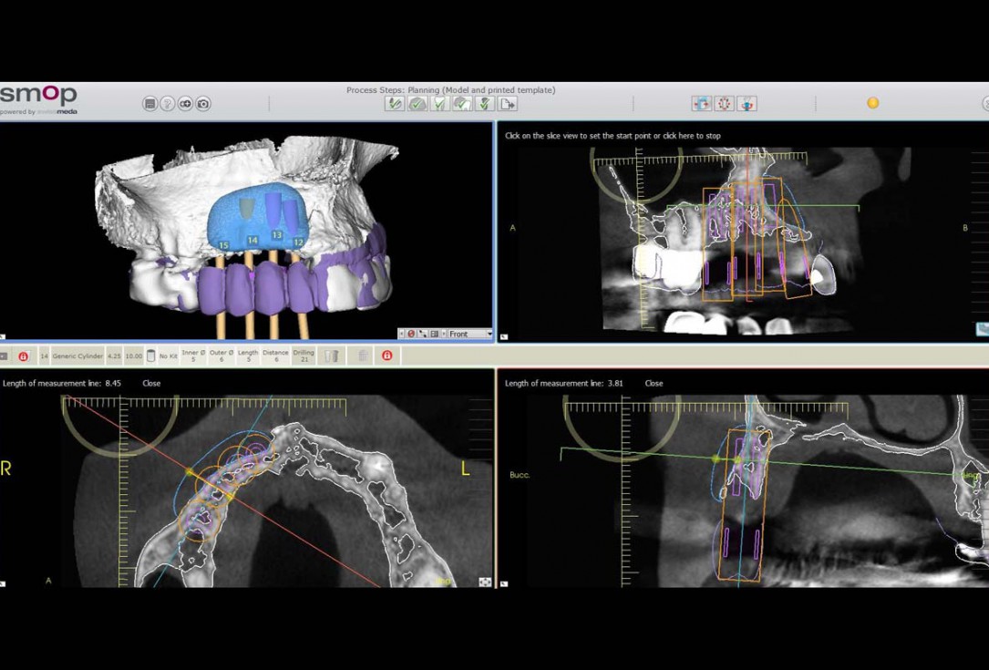 Smile rehabilitation in the anterior maxilla with maxgraft® bonebuilder - Dres. Dagba and Mourlaas  