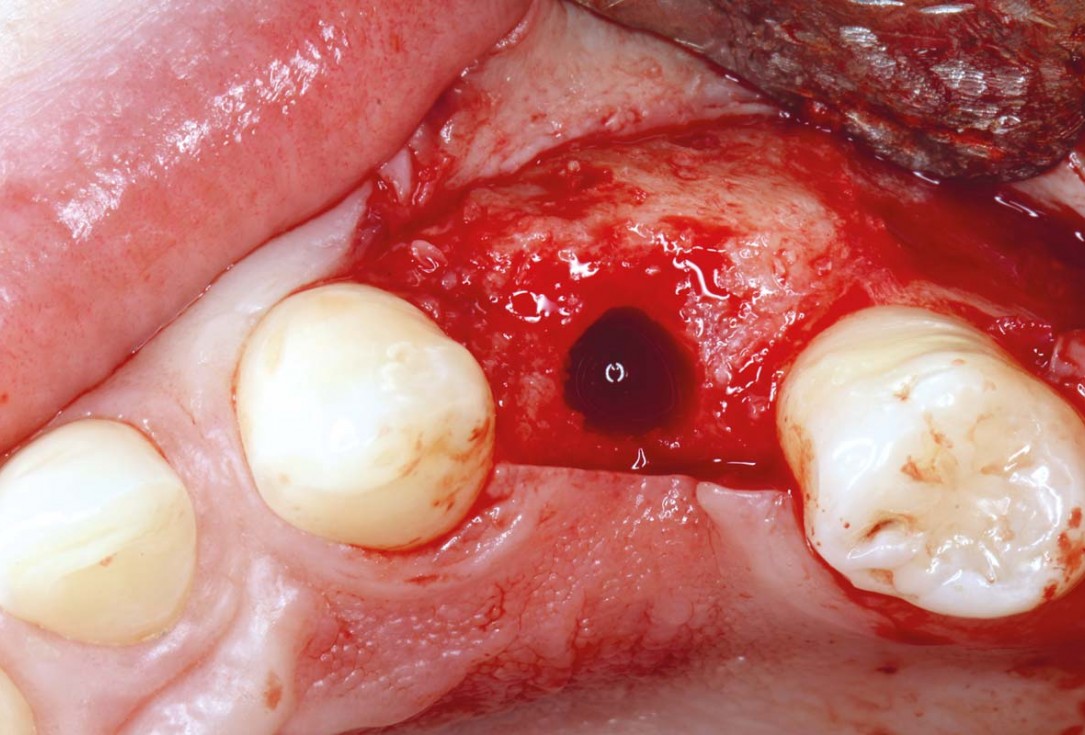 Ridge reconstruction with maxgraft® block in the posterior maxilla - Dr. A. Puišys