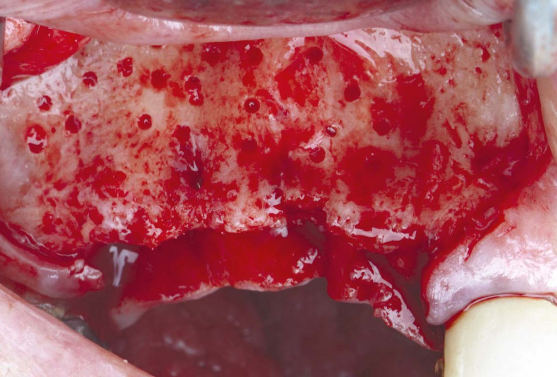 Smile rehabilitation in the anterior maxilla with maxgraft® bonebuilder - Dres. Dagba and Mourlaas  