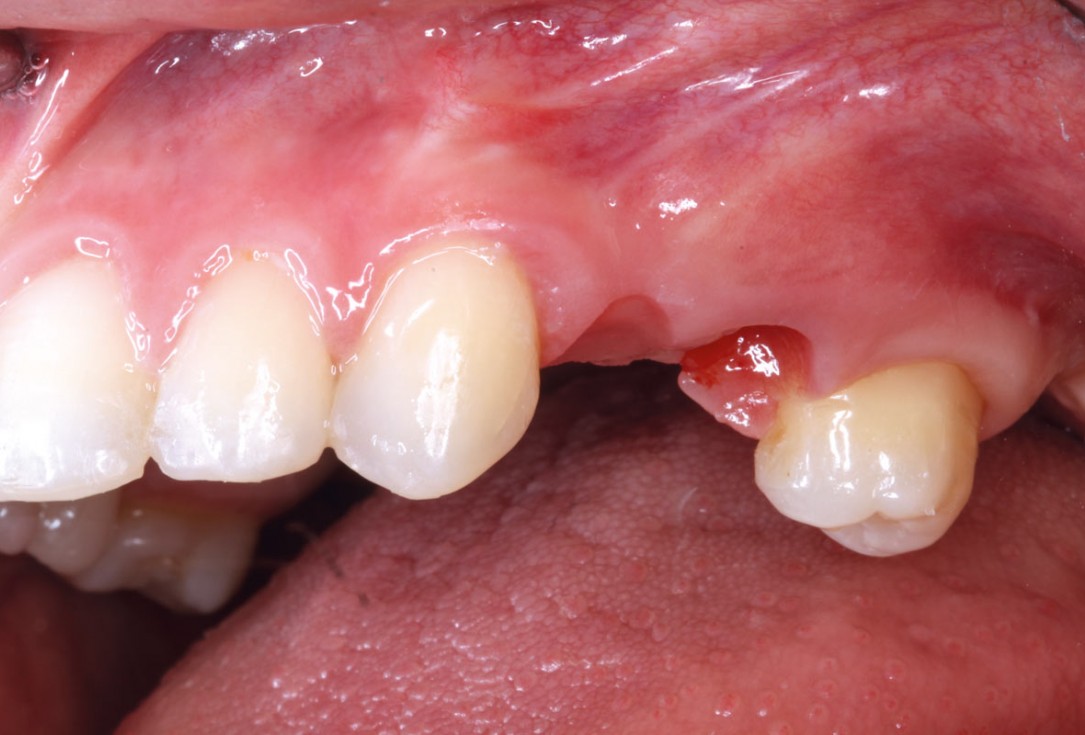 Ridge reconstruction with maxgraft® block in the posterior maxilla - Dr. A. Puišys