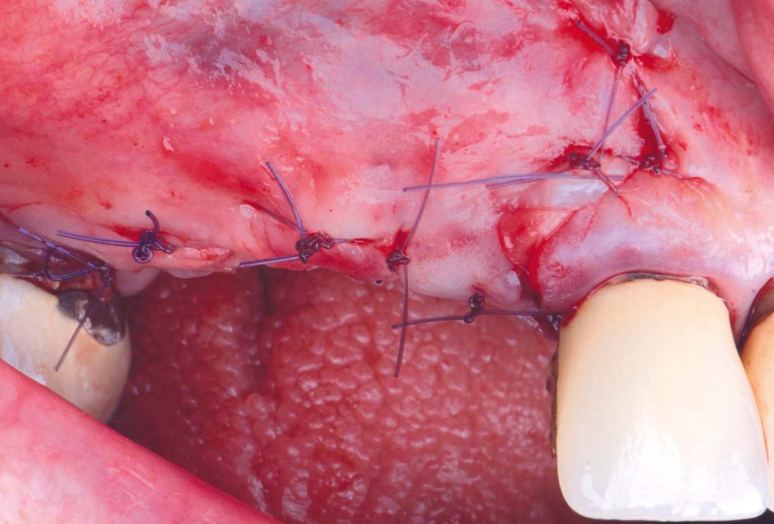 Smile rehabilitation in the anterior maxilla with maxgraft® bonebuilder - Dres. Dagba and Mourlaas  