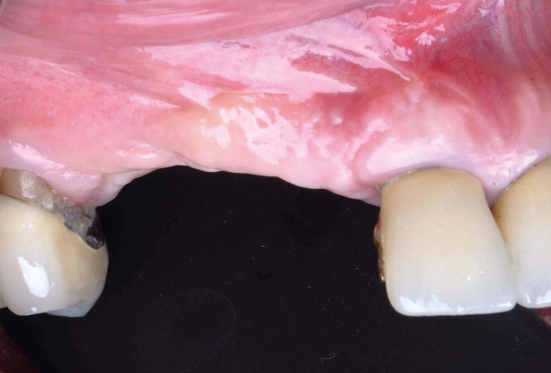 Smile rehabilitation in the anterior maxilla with maxgraft® bonebuilder - Dres. Dagba and Mourlaas  