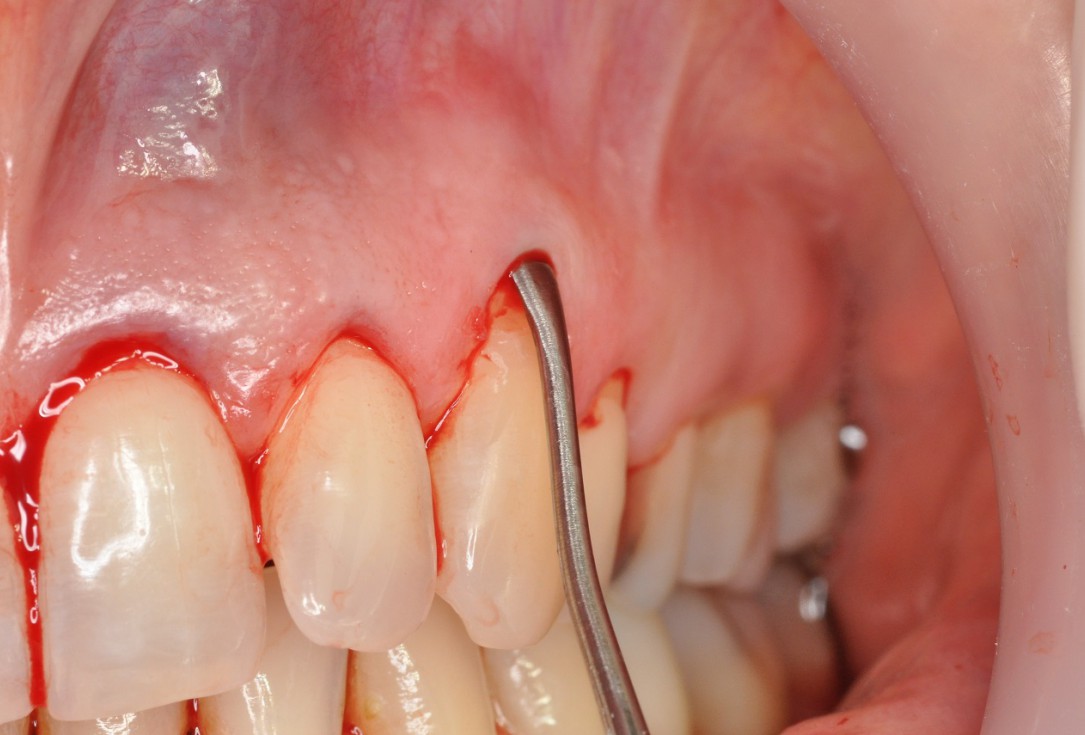 Multiple gingival recessions treated by MCAT in conjunction with mucoderm® and Straumann® Emdogain® - Hangyási