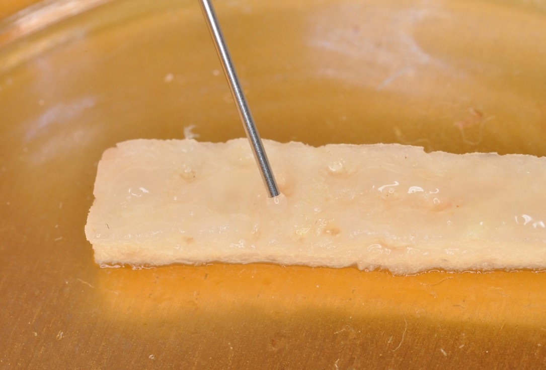 Multiple gingival recessions treated by MCAT in conjunction with mucoderm® and Straumann® Emdogain® - Hangyási