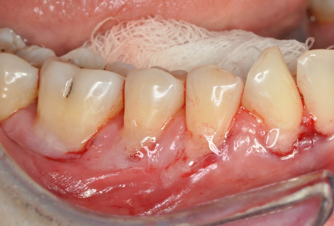Multiple gingival recessions treated by MCAT in conjunction with mucoderm® and Straumann® Emdogain® - Hangyási