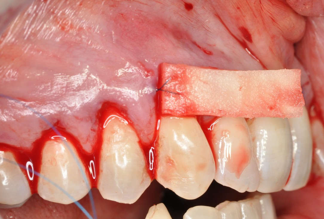 Multiple gingival recessions treated by MCAT in conjunction with mucoderm® and Straumann® Emdogain® - Hangyási