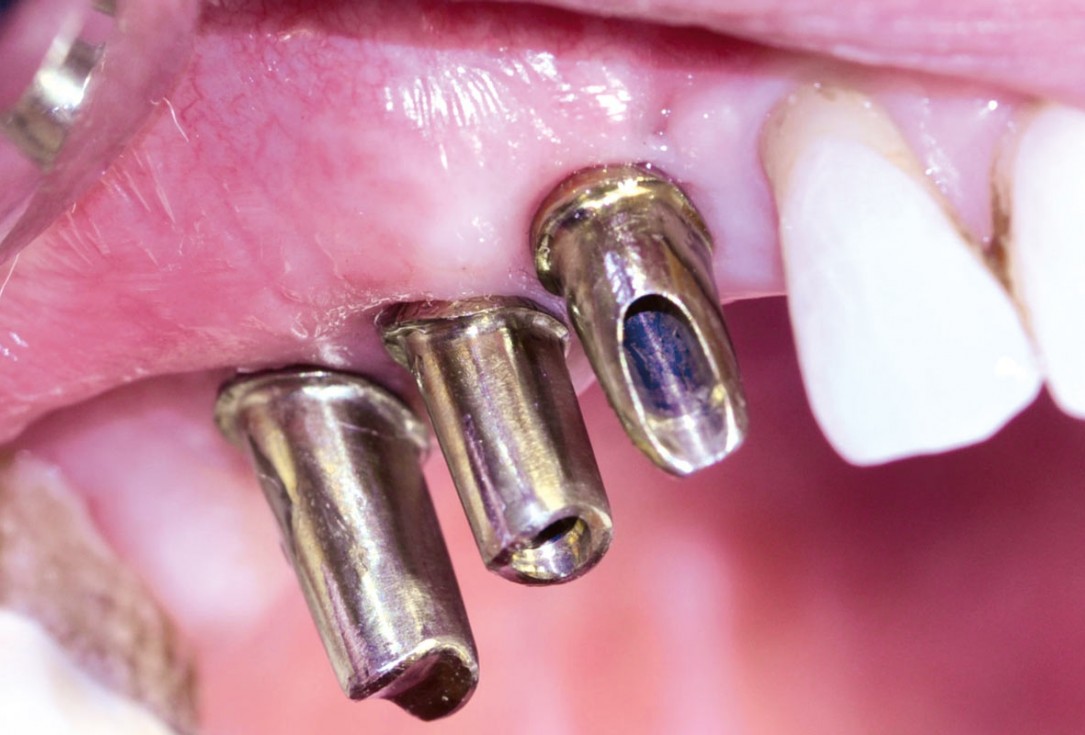 Ridge augmentation with maxgraft® bonebuilder and sinus floor elevation – Dr. K.P. Schiechl