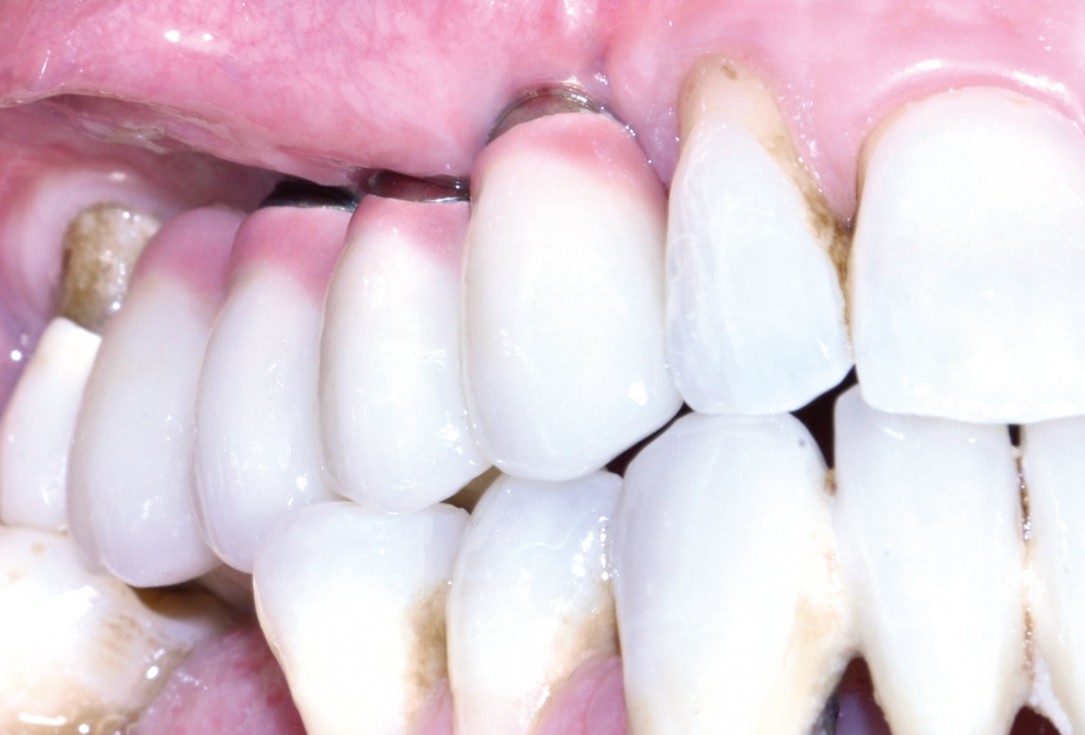 Ridge augmentation with maxgraft® bonebuilder and sinus floor elevation – Dr. K.P. Schiechl