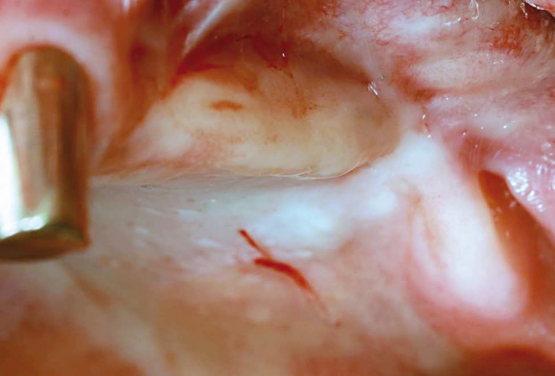 Three-dimensional augmentation in the mandible with maxgraft® cortico –  J. Kielhorn and Dr. S. Hölzer