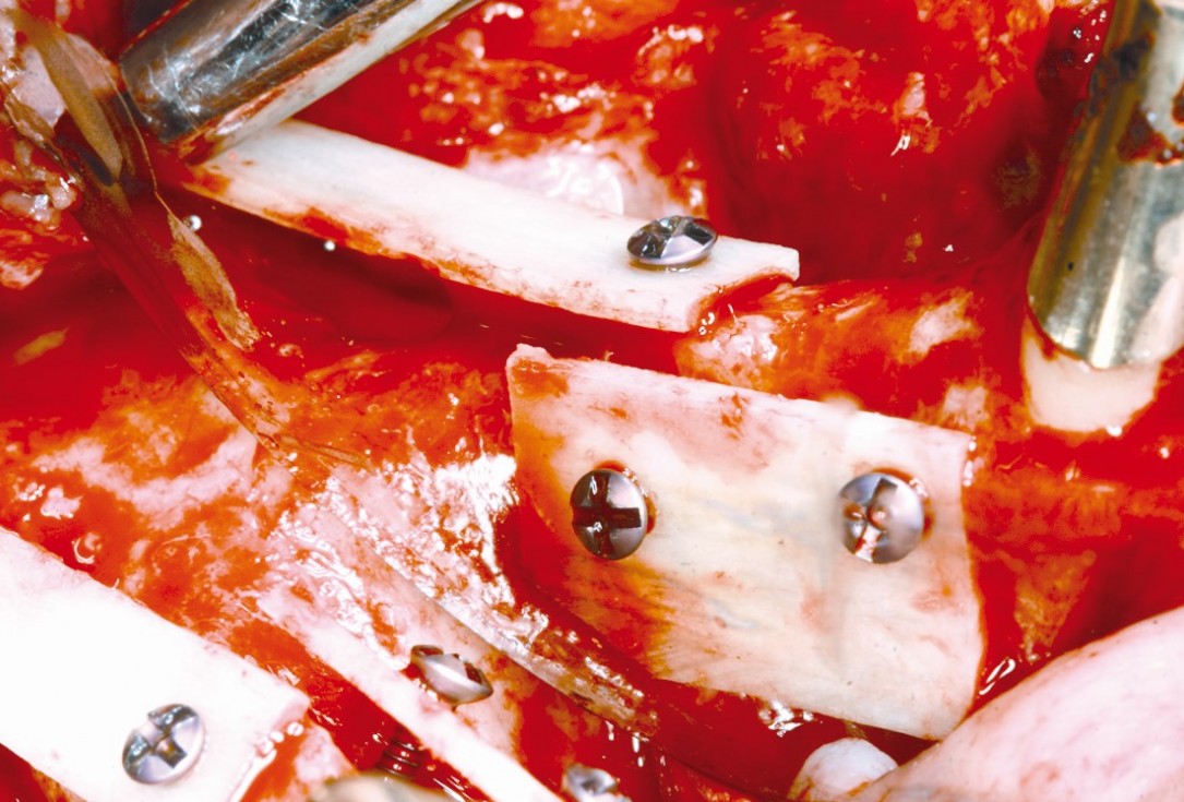 Three-dimensional augmentation in the mandible with maxgraft® cortico –  J. Kielhorn and Dr. S. Hölzer