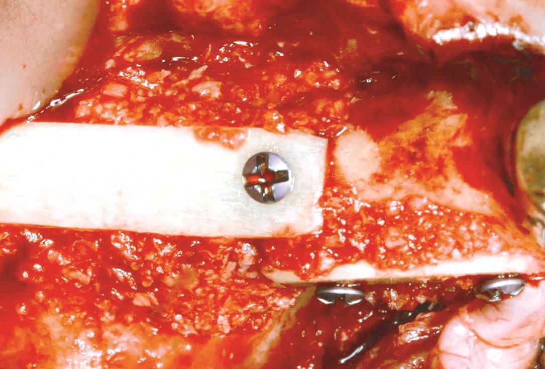 Three-dimensional augmentation in the mandible with maxgraft® cortico –  J. Kielhorn and Dr. S. Hölzer