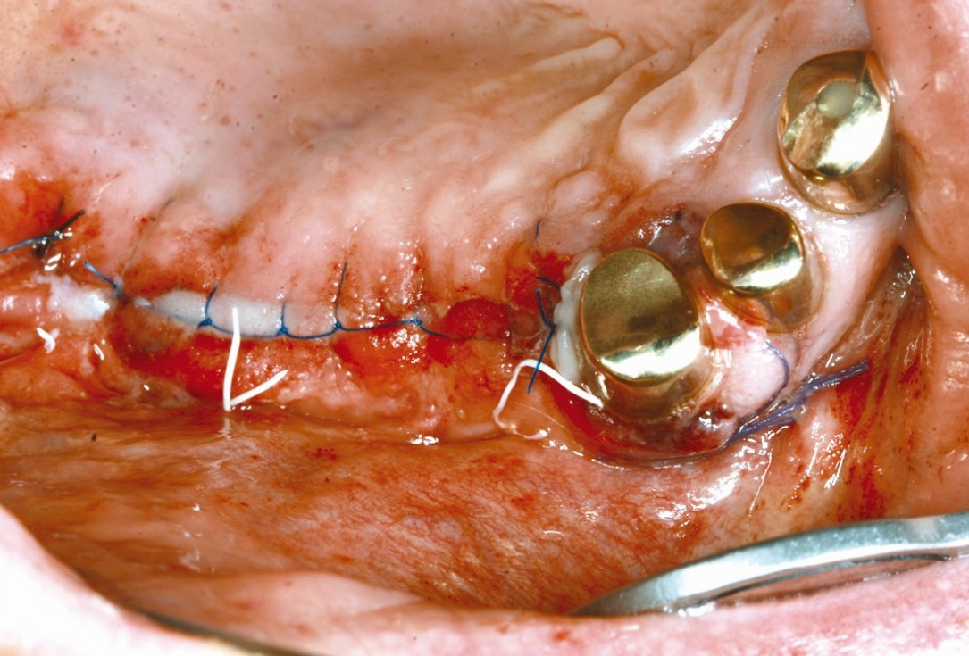 Three-dimensional augmentation in the mandible with maxgraft® cortico –  J. Kielhorn and Dr. S. Hölzer