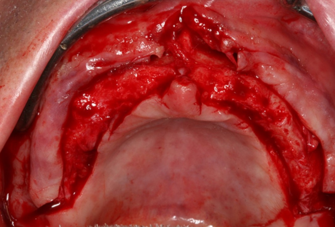 botiss maxresorb® and collprotect® membrane for bone splitting - case by Dr J Neugebauer