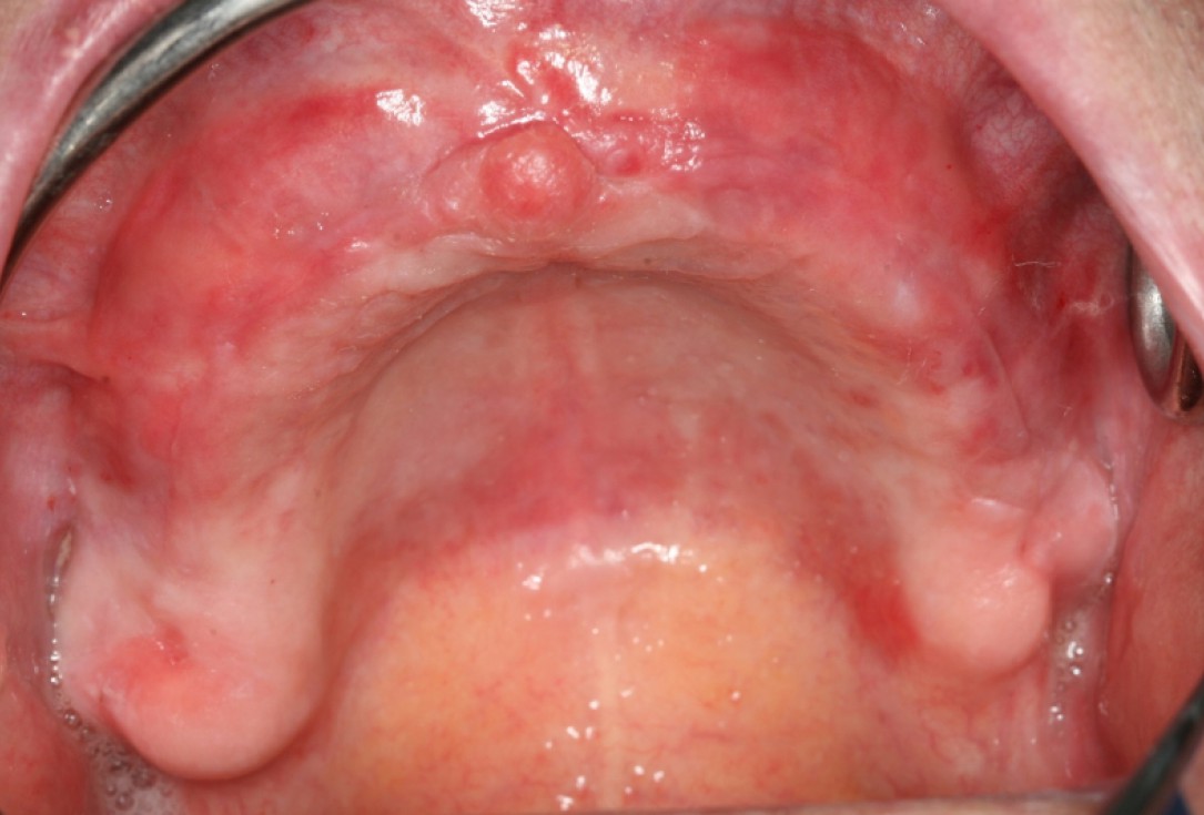 botiss maxresorb® and collprotect® membrane for bone splitting - case by Dr J Neugebauer