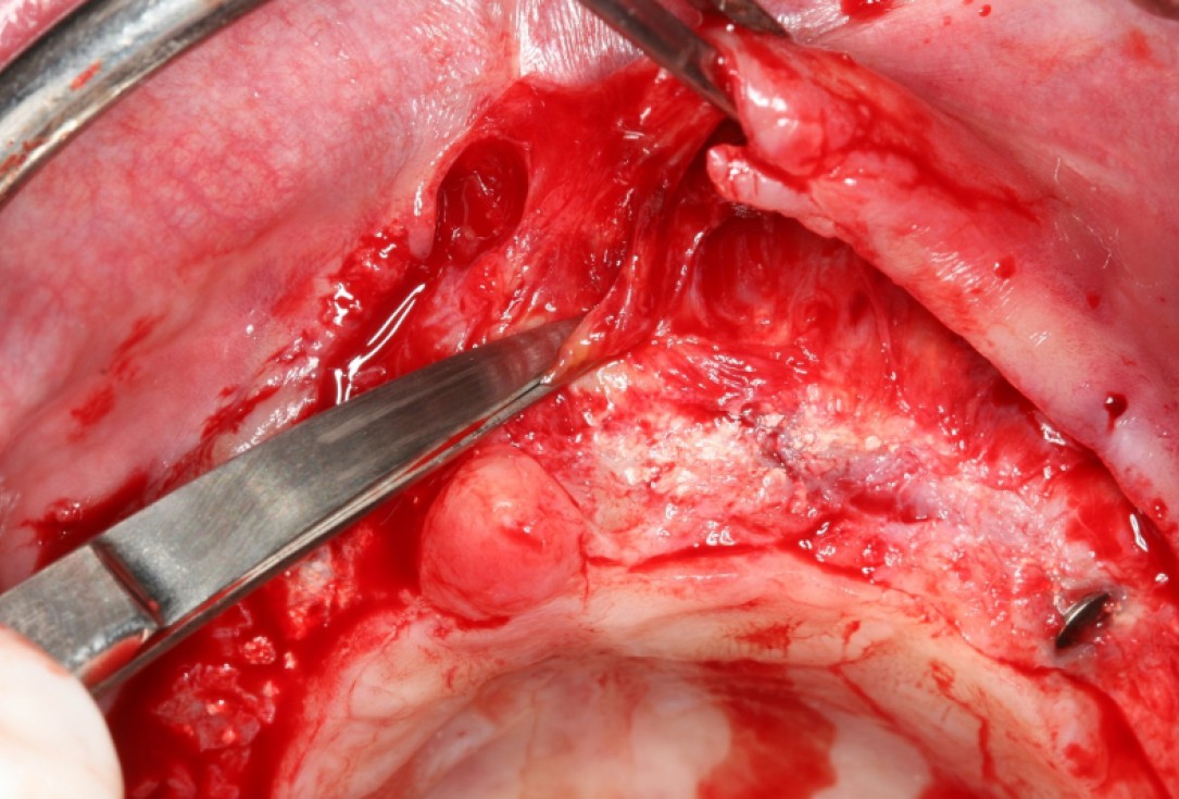 botiss maxresorb® and collprotect® membrane for bone splitting - case by Dr J Neugebauer