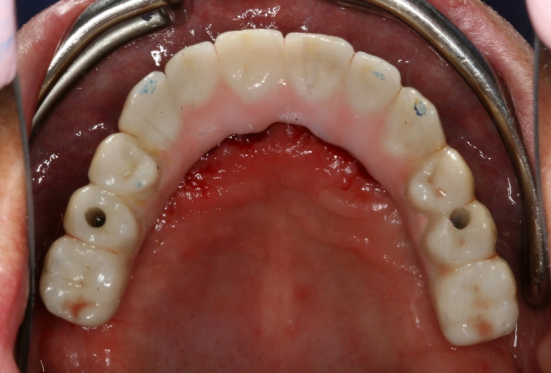 botiss maxresorb® and collprotect® membrane for bone splitting - case by Dr J Neugebauer