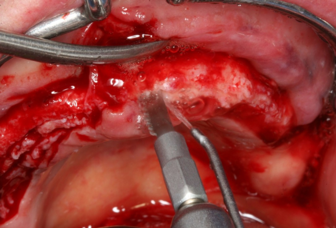 botiss maxresorb® and collprotect® membrane for bone splitting - case by Dr J Neugebauer