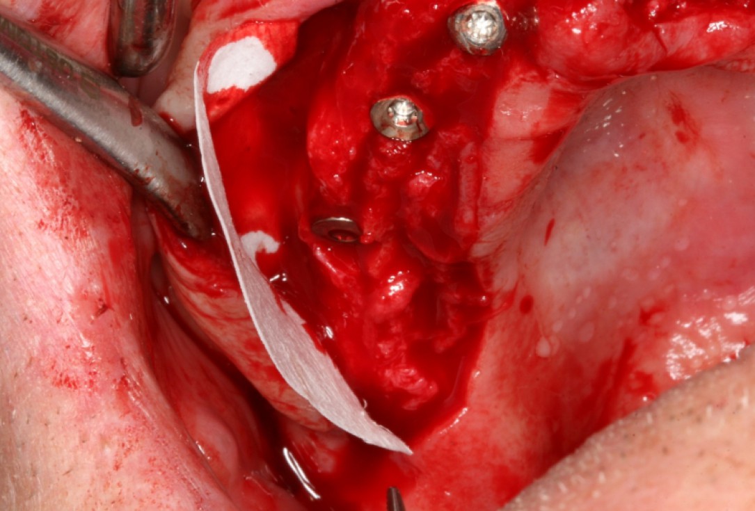 botiss maxresorb® and collprotect® membrane for bone splitting - case by Dr J Neugebauer