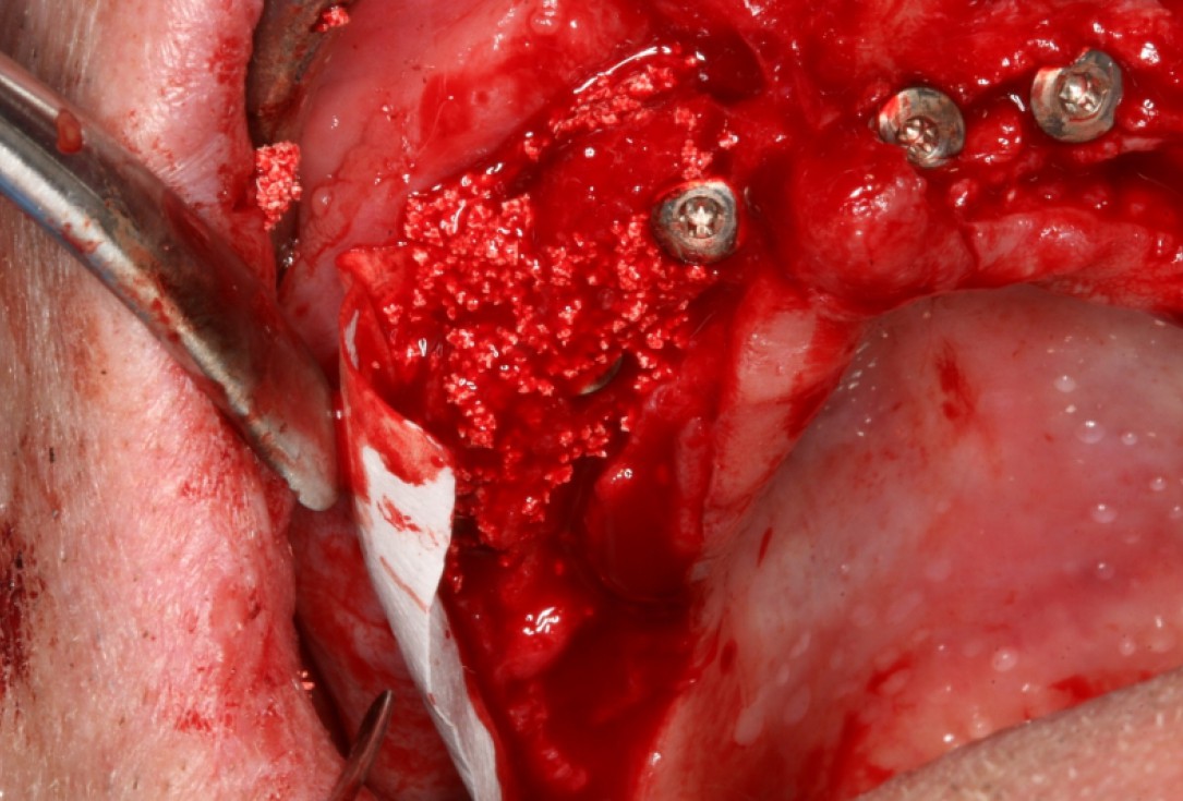 botiss maxresorb® and collprotect® membrane for bone splitting - case by Dr J Neugebauer