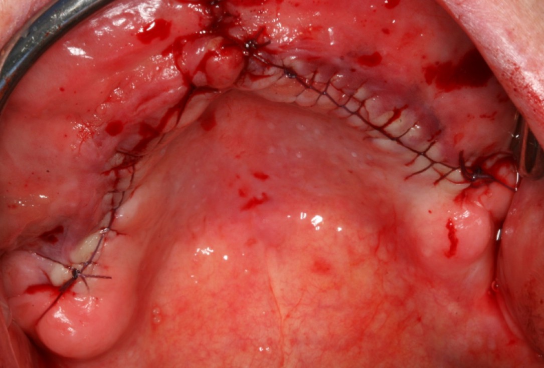 botiss maxresorb® and collprotect® membrane for bone splitting - case by Dr J Neugebauer