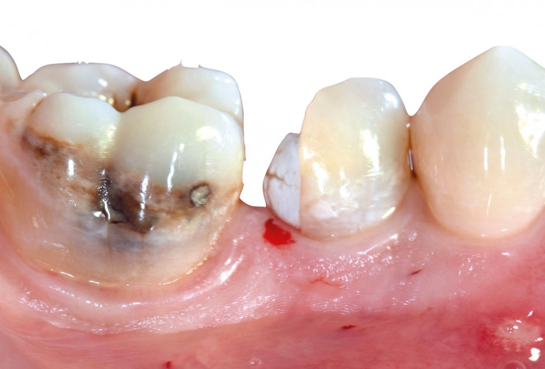 mucoderm® around single implant at second stage surgery