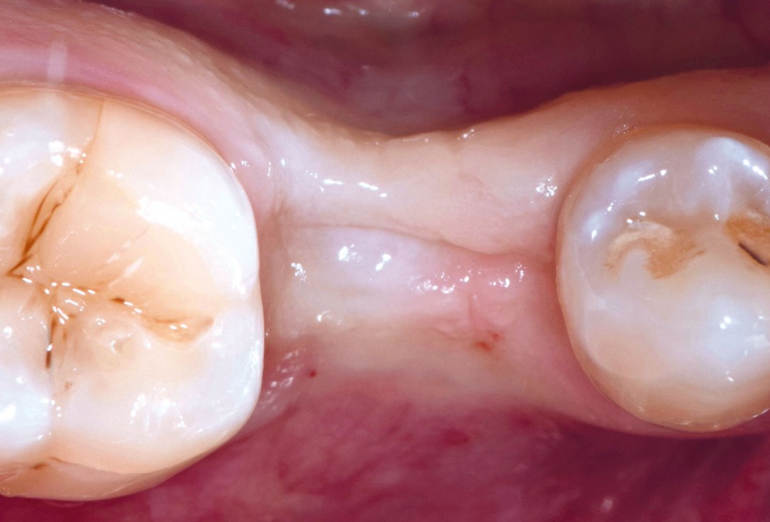 mucoderm® around single implant at second stage surgery