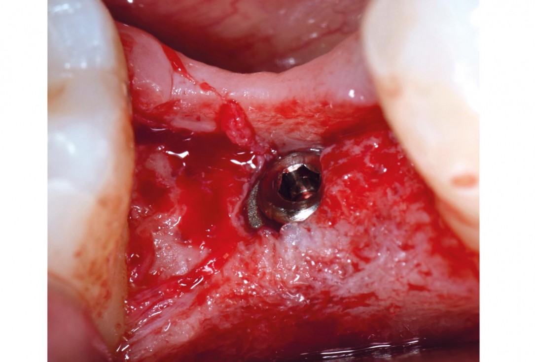 mucoderm® around single implant at second stage surgery