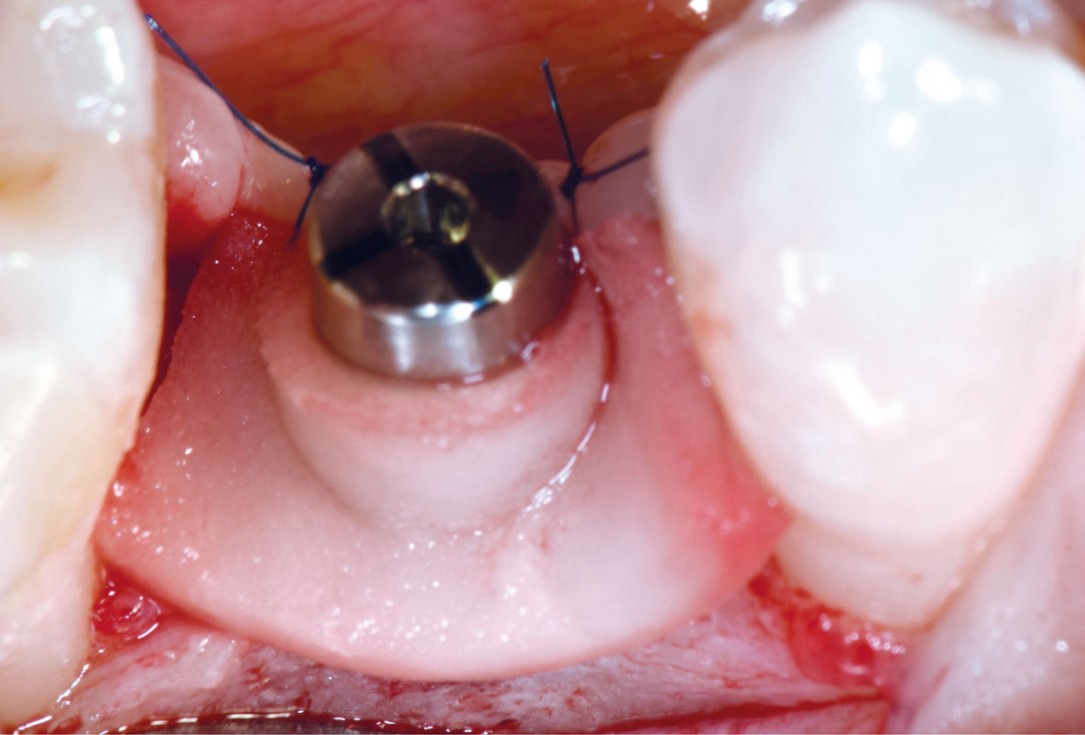 mucoderm® around single implant at second stage surgery