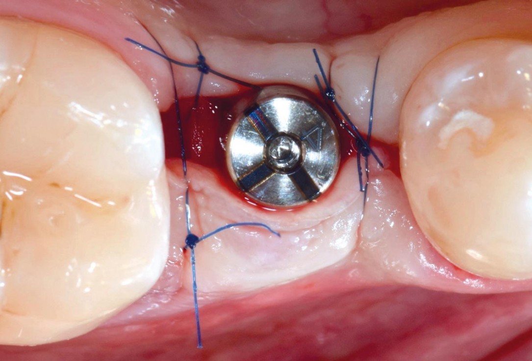 mucoderm® around single implant at second stage surgery