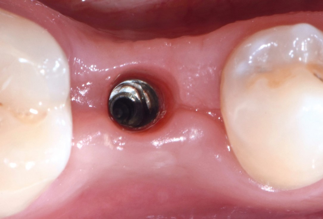 mucoderm® around single implant at second stage surgery