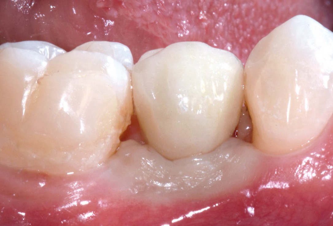 mucoderm® around single implant at second stage surgery