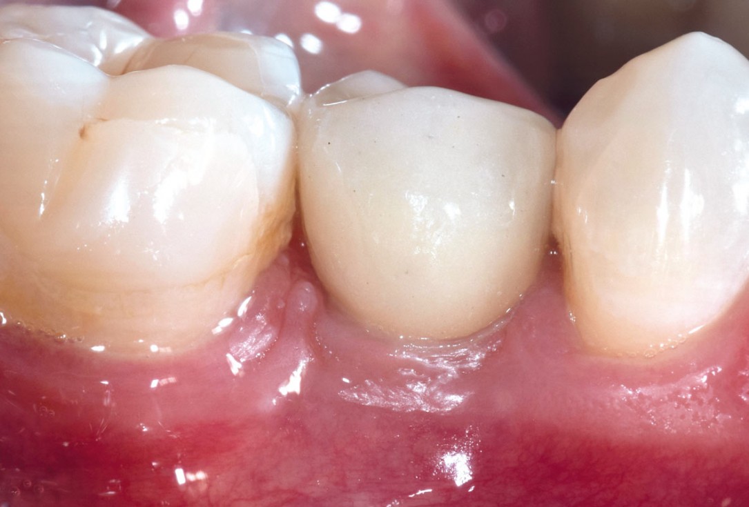 mucoderm® around single implant at second stage surgery