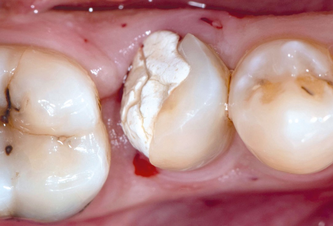 mucoderm® around single implant at second stage surgery