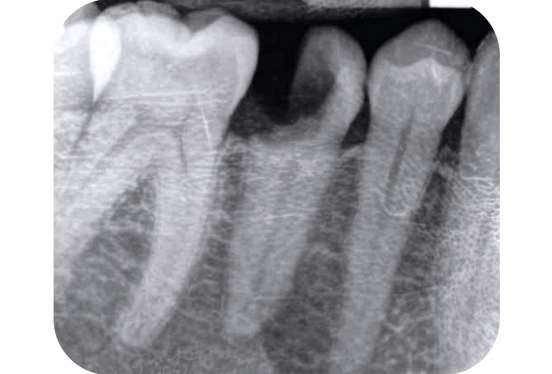 mucoderm® around single implant at second stage surgery