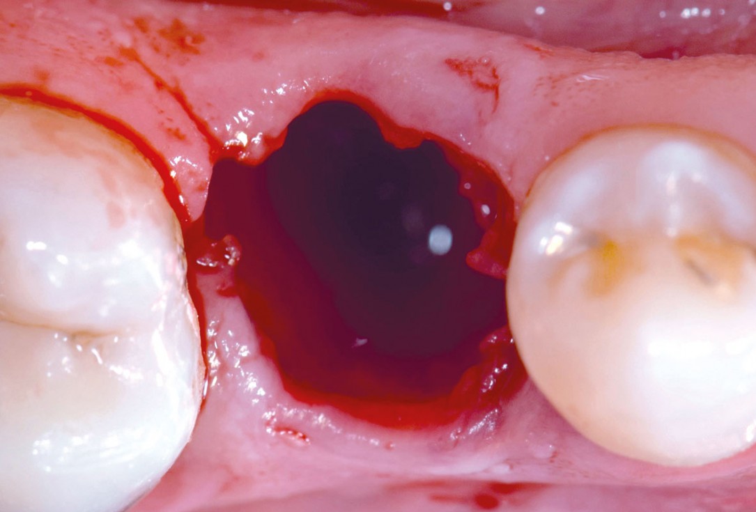 mucoderm® around single implant at second stage surgery