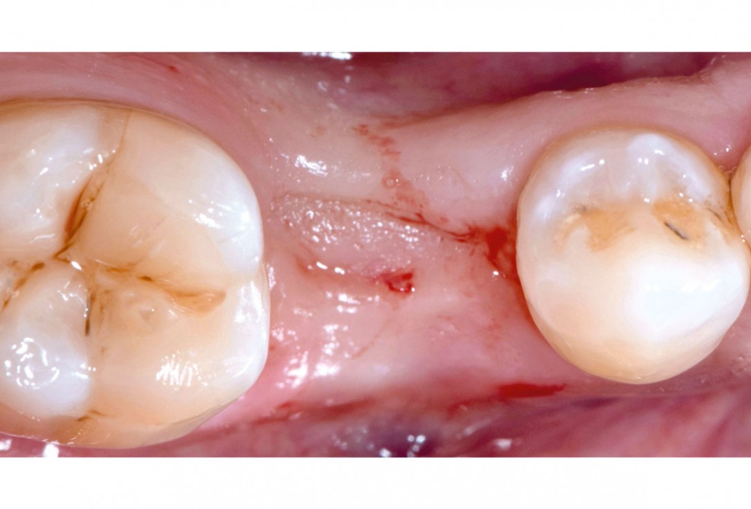mucoderm® around single implant at second stage surgery