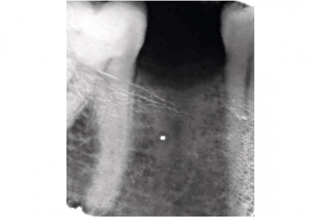 mucoderm® around single implant at second stage surgery
